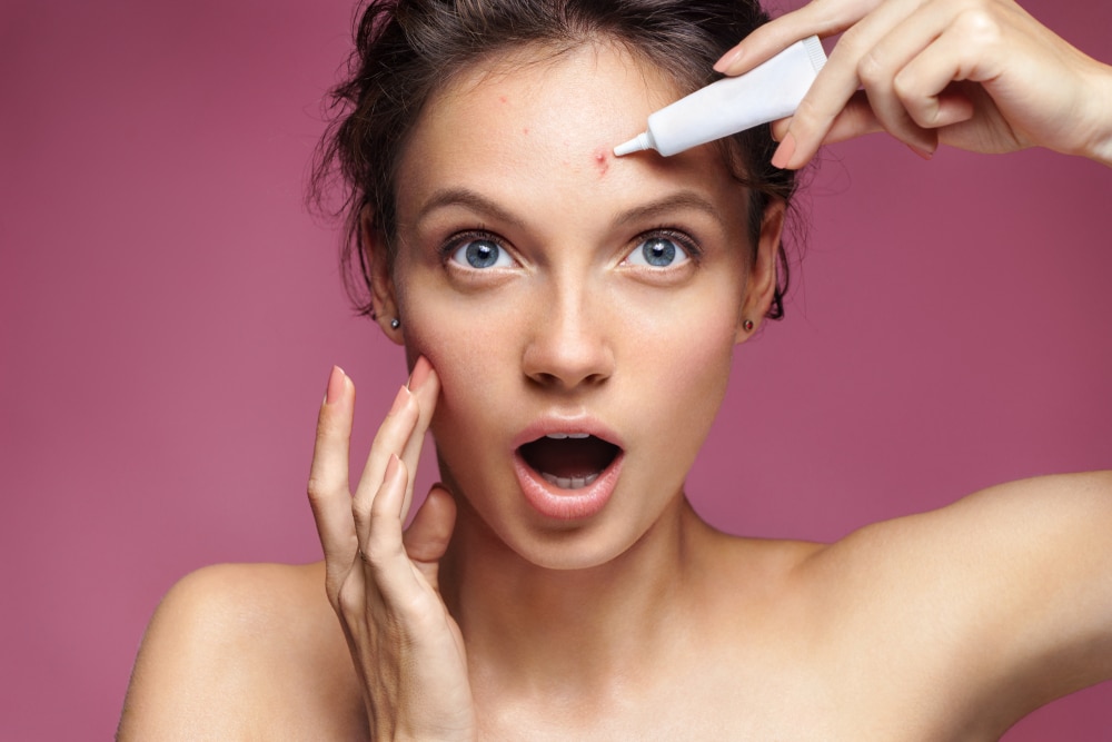 photo of a girl applying cream on the acne scar on her forehead