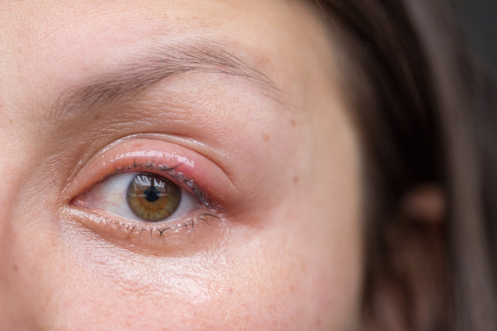 home remedies for eye stye