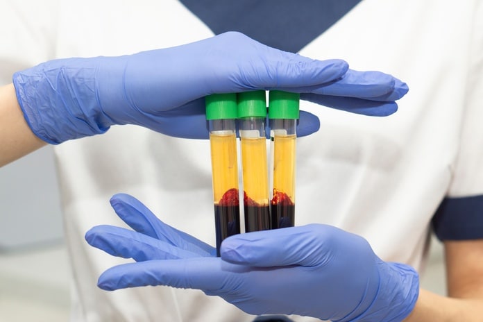 A close-up of a person wearing blue gloves and a white shirt holding three tubes of plasma with green caps.